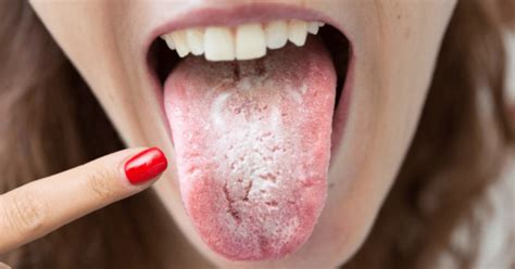  &0183;&32;Oral thrush or candidiasis is a yeast infection of the mucus lining of the mouth and tongue caused by a form of a fungus called Candida. . Oral thrush reddit